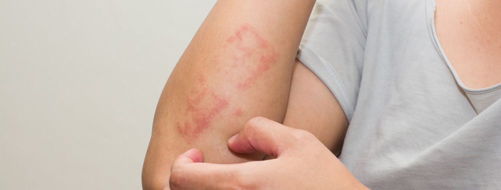 HOMEOPATHY CAN TREAT SKIN ALLERGY