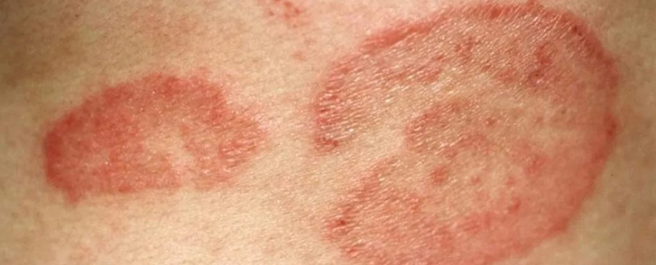 TINEA TREATMENT