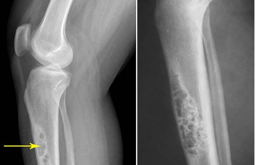 ADAMANTINOMA TREATMENT