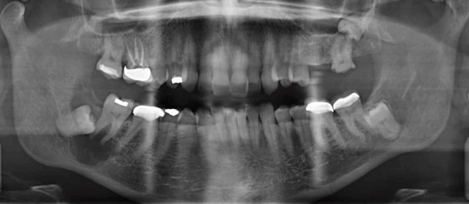 DENTIGEROUS CYST