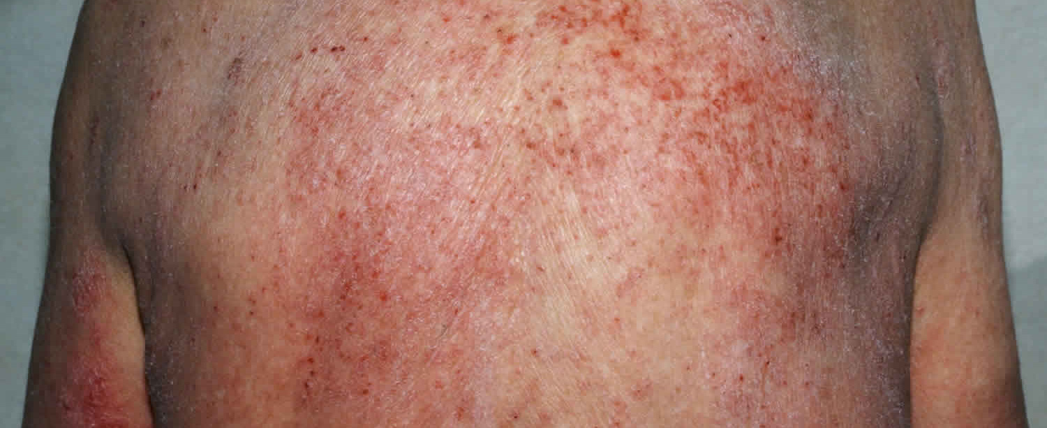THE HYPER EOSINOPHILIC SYNDROME (HES)