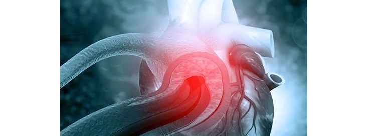 TAKAYASU'S ARTERITIS (PULSELESS DISEASE)