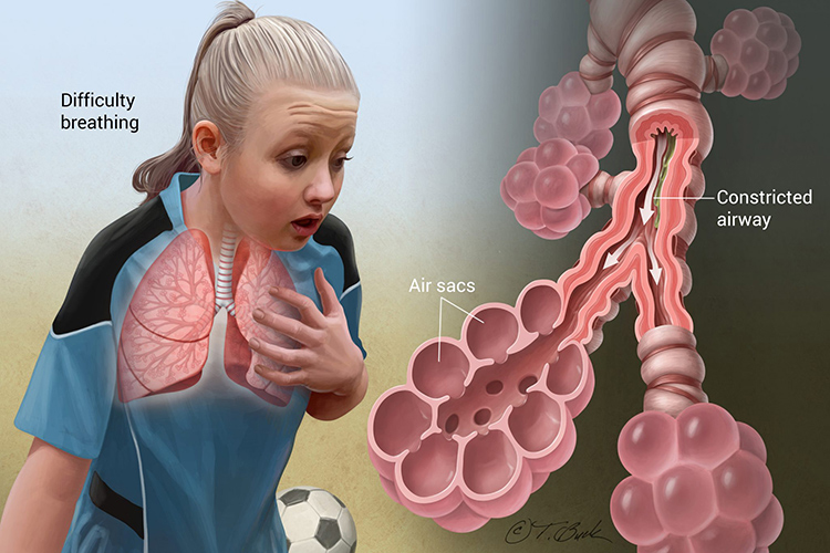 HOMEOPATHY IS EFFECTIVE FOR ASTHMA