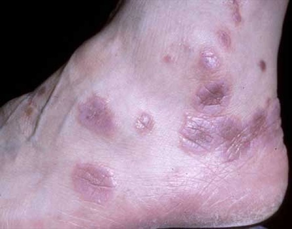 Lichen Planus